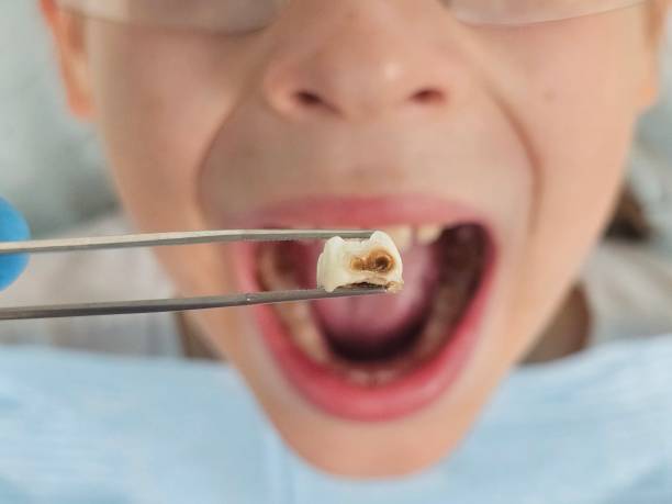 Best Emergency Treatment for Oral Infections in Albion, IL